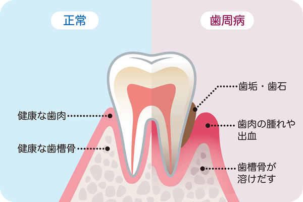 が 痒い 歯茎 歯茎がかゆいのはストレスや親知らずのせい？７つの原因と対処法！